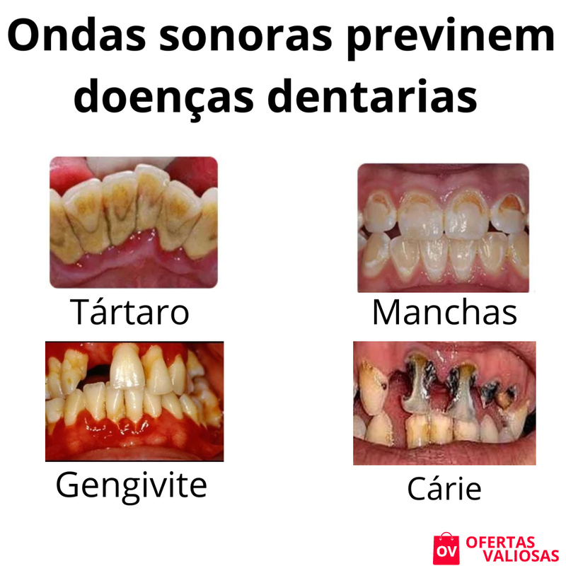 Limpador Dental Sonic©-Removedor de Tartaro, Manchas e Sujeiras Indesejadas